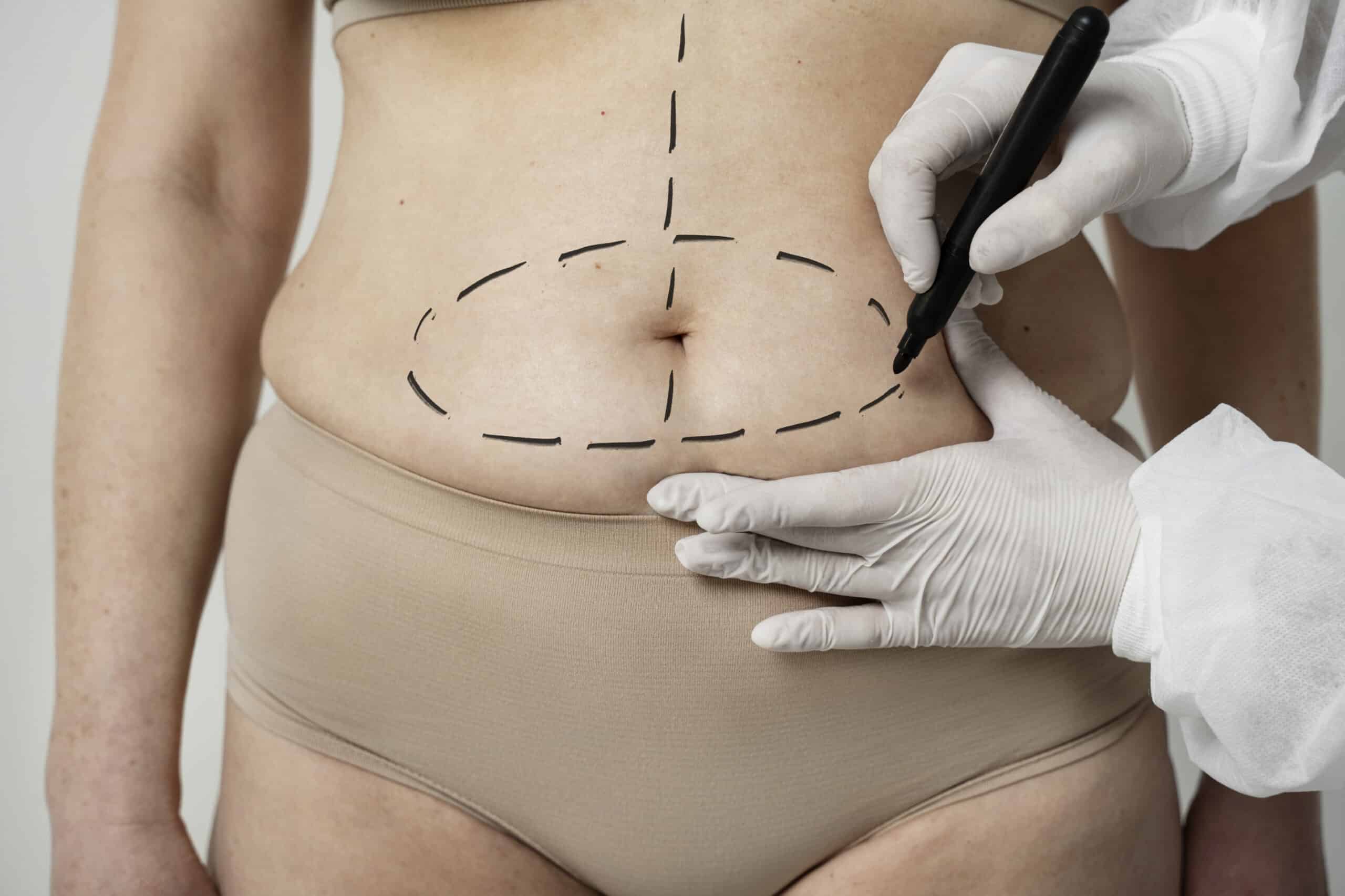 O que você deve saber sobre a cirurgia bariátrica e por que o acompanhamento nutricional pós bariátrica é importante?